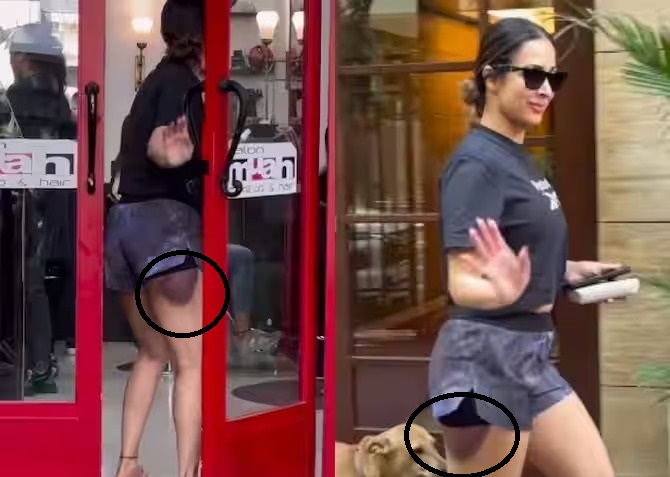 Malaika Arora was seen hiding her leg wounds, video goes viral